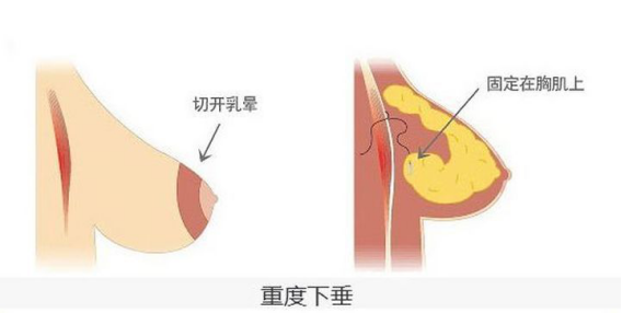 做假体隆胸可以改善胸下垂吗?做隆胸后的修复率高吗?