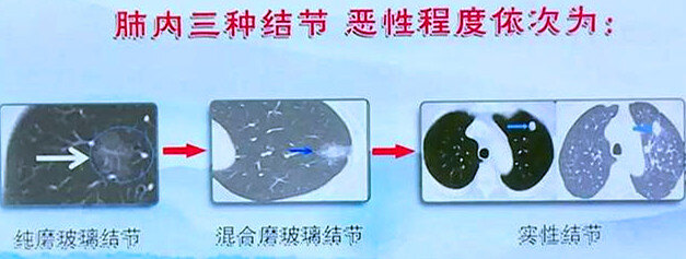 肺毛玻璃结节:中西医结合治疗模式更好莫要"冷观察"