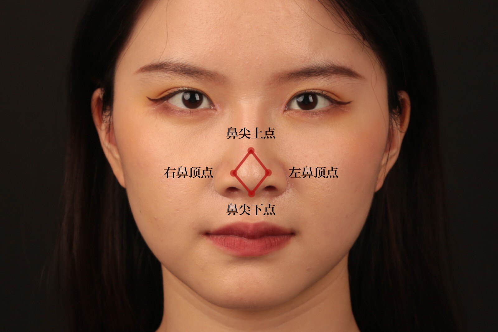 正常的鼻尖形态,鼻顶部角度为 60 度,形态 近似等边三角形.