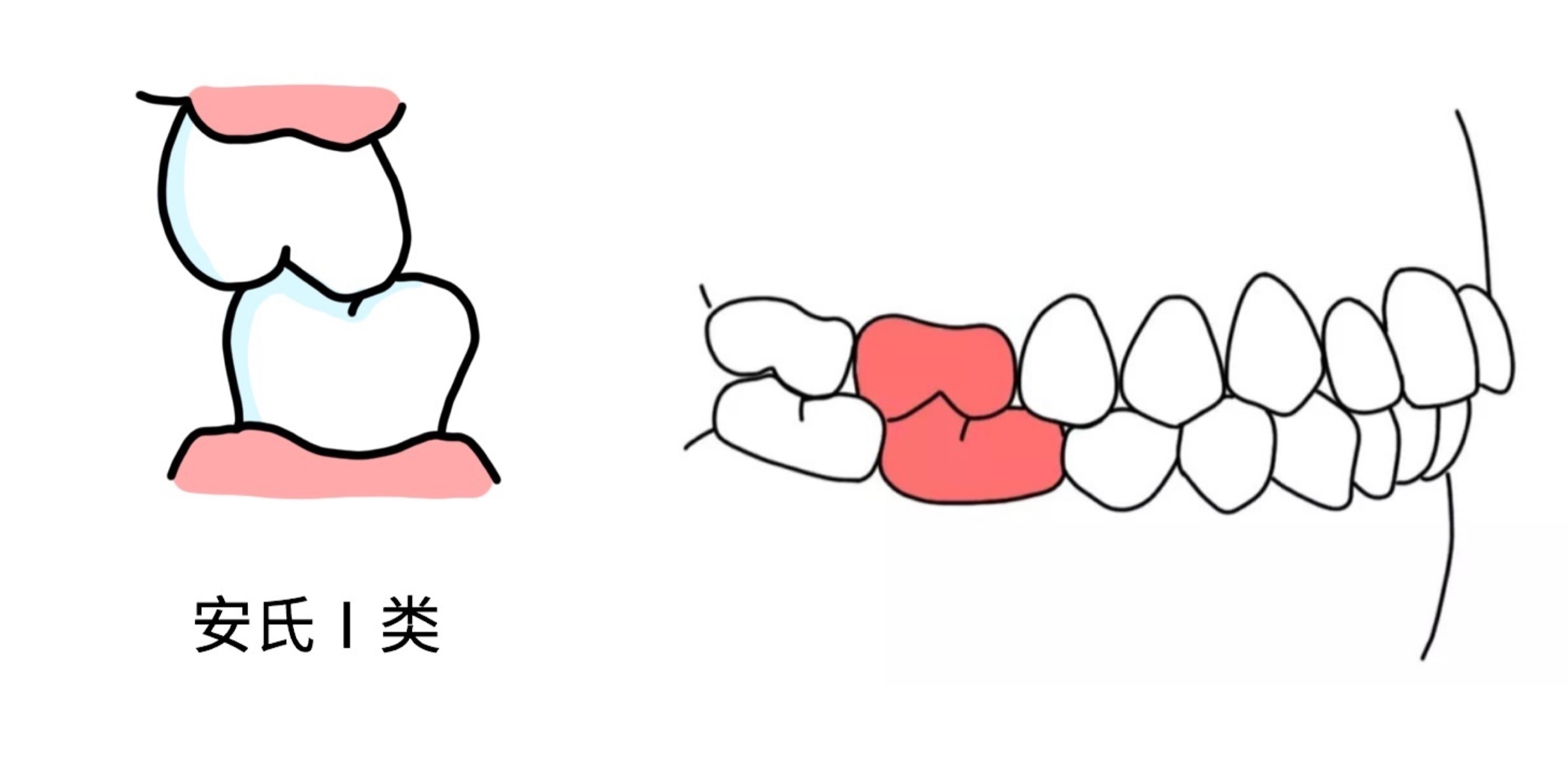 医生口中常说的i类Ⅱ类Ⅲ类错颌畸形是什么意思