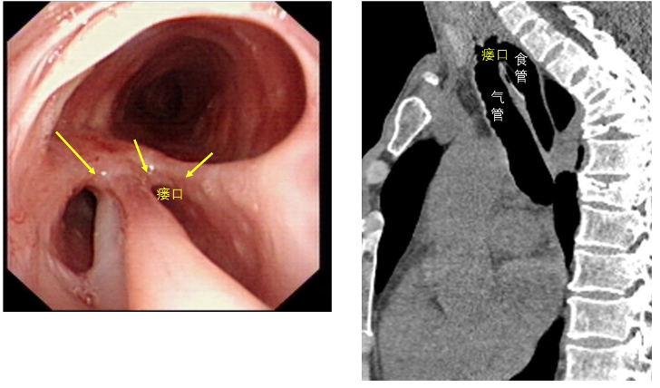 亡羊补牢,尤为未晚 —— 一例复杂气管食管瘘的成功救治