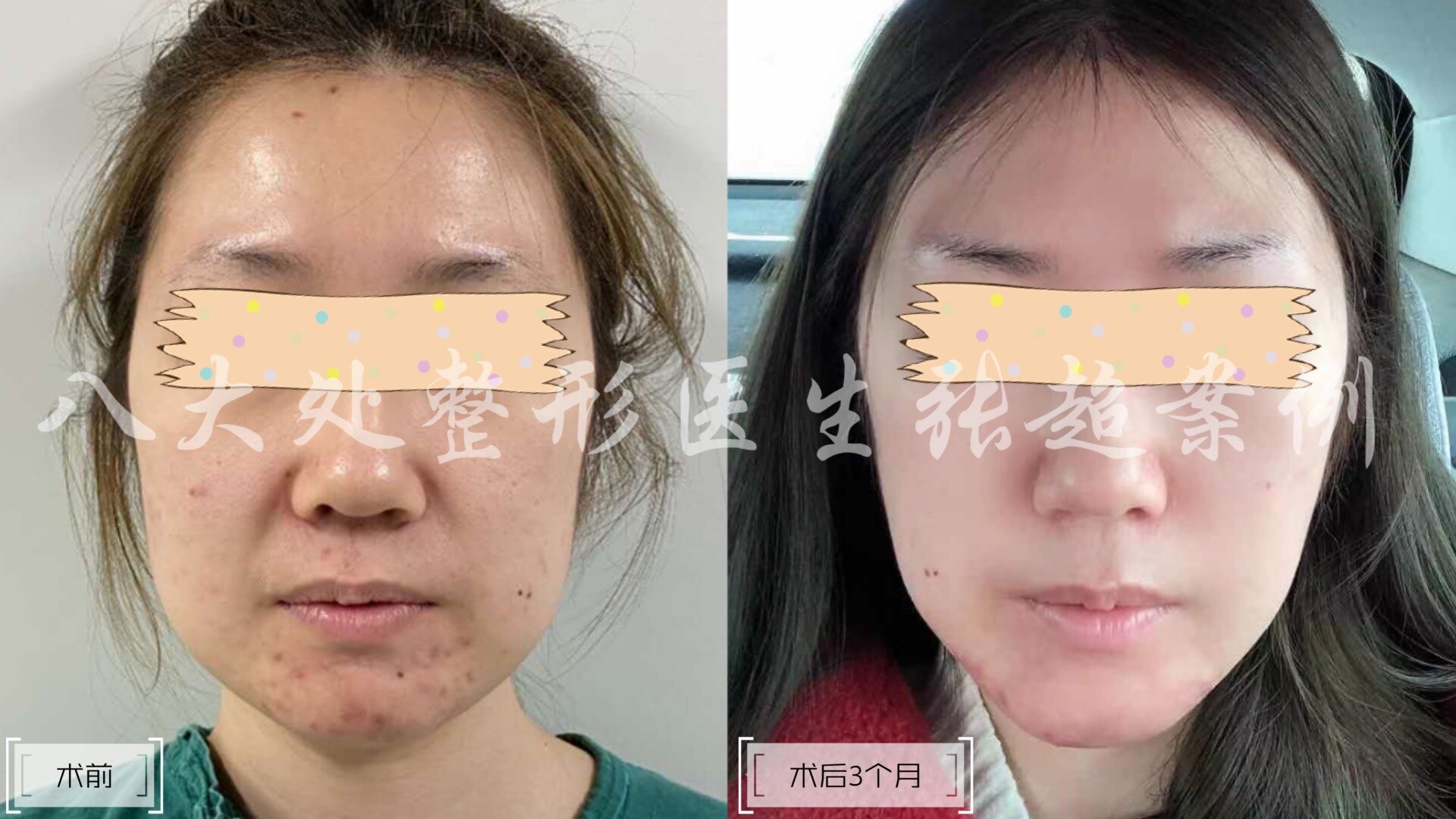 八大处张超面部吸脂案例合集(不定期持续更新)