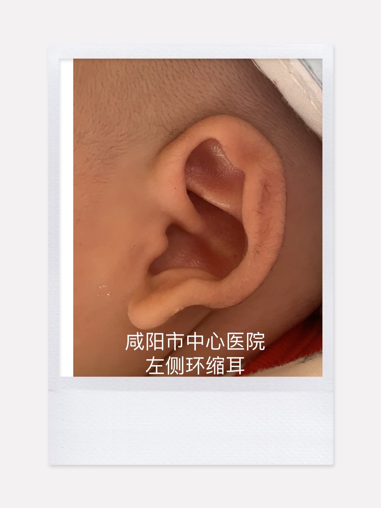 新生儿耳廓畸形科普一
