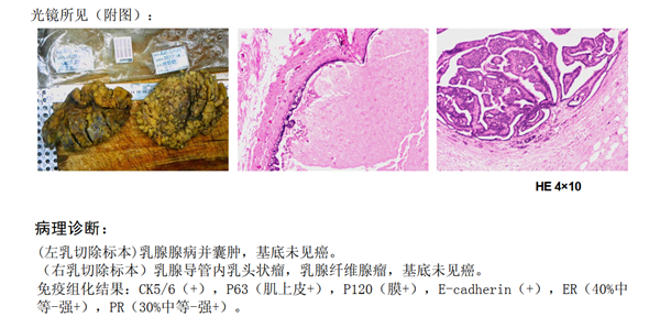 手术病理新看点四乳腺小叶原位癌是乳腺癌吗