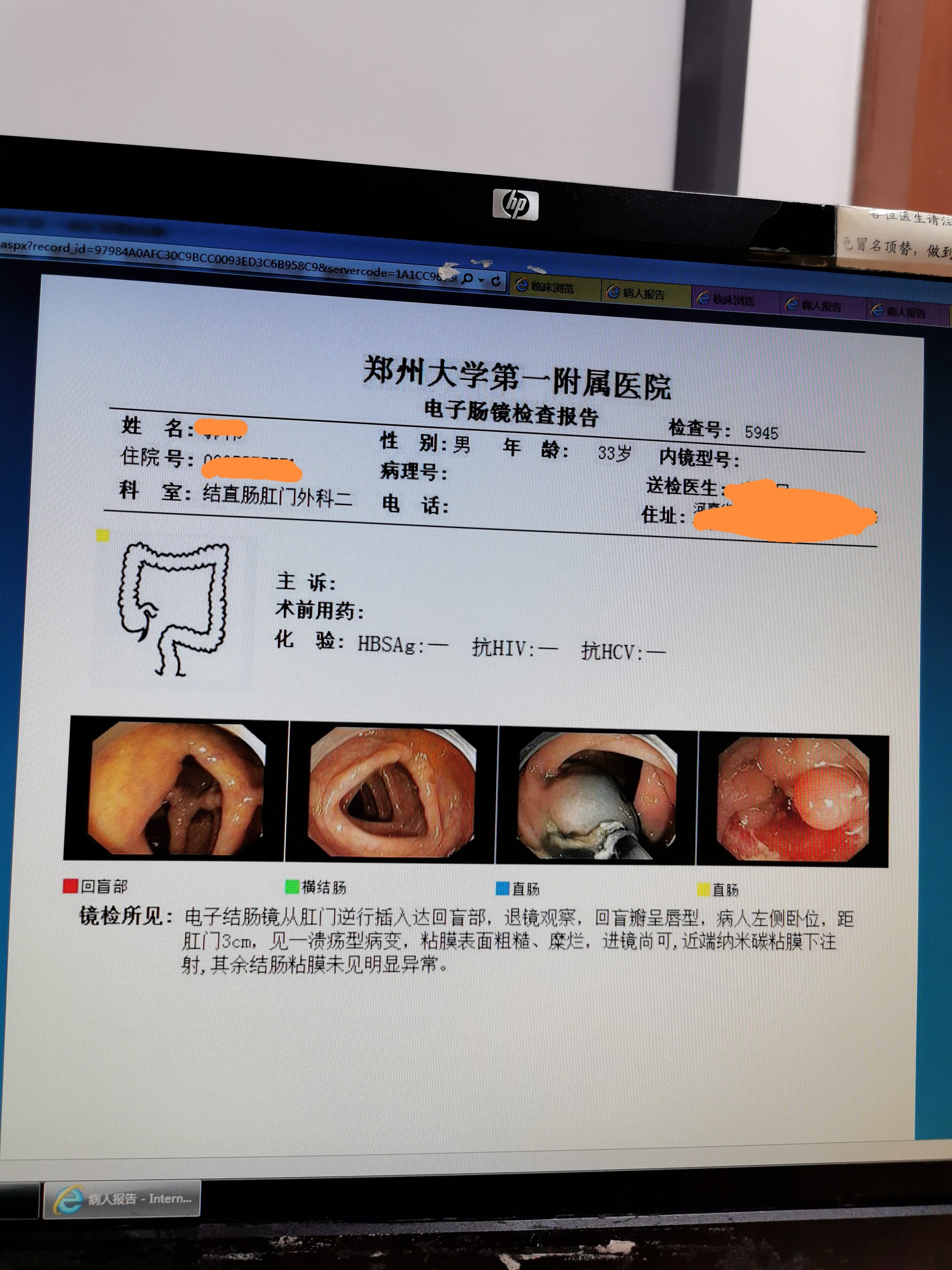 距离肛缘3cm的直肠癌能保住肛门吗?