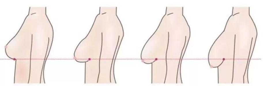 乳房下垂怎么办乳房下垂可以用假体隆胸吗术后注意什么