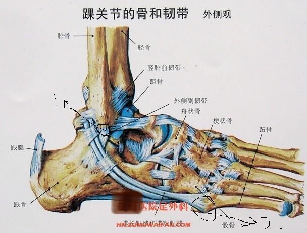 第五跖骨基底部陈旧骨折的认识与处理