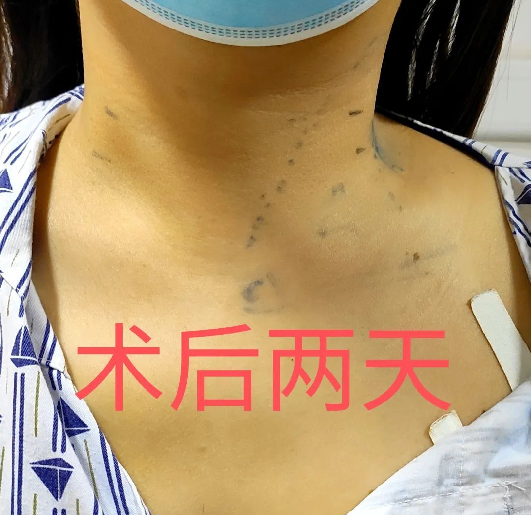 王培松副主任医师为一位巨大甲状腺结节患者实施经腋窝腔镜甲状腺手术