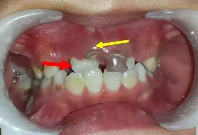宝宝龋齿,口腔卫生差的具体危害