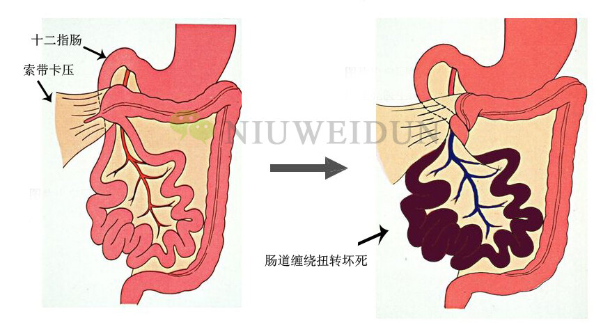 故临床表现主要为反复胆汁性呕吐等上消化道梗阻症状;但若发生中肠