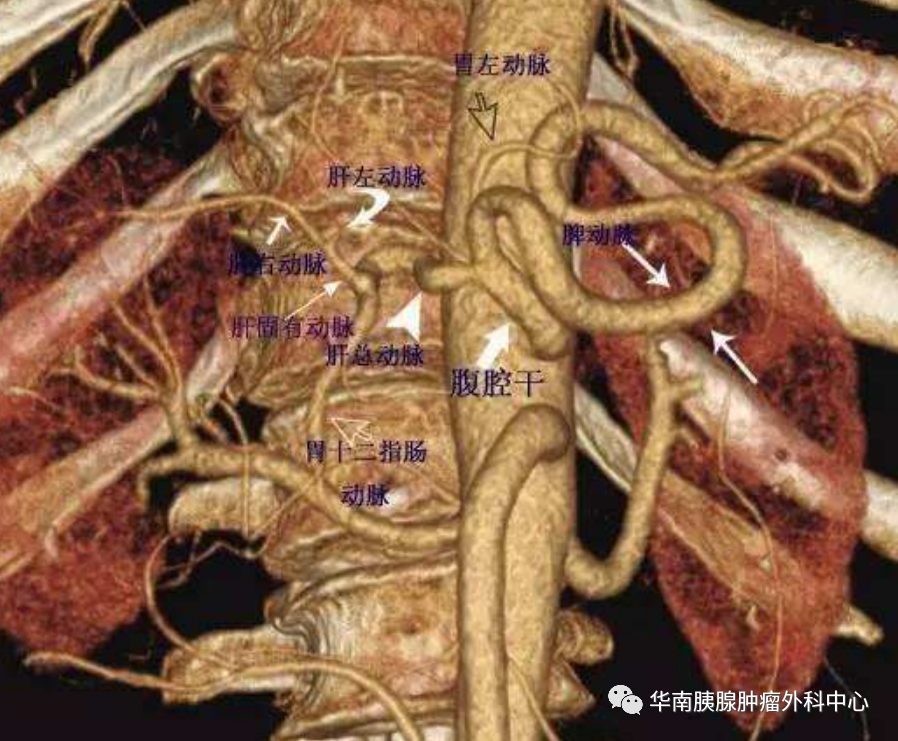 手术的难点在于该患者存在血管变异(肝右动脉从肝总动脉根部发出,走在