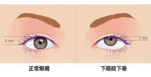做双眼皮手术能解决眼皮松弛下垂的问题吗?