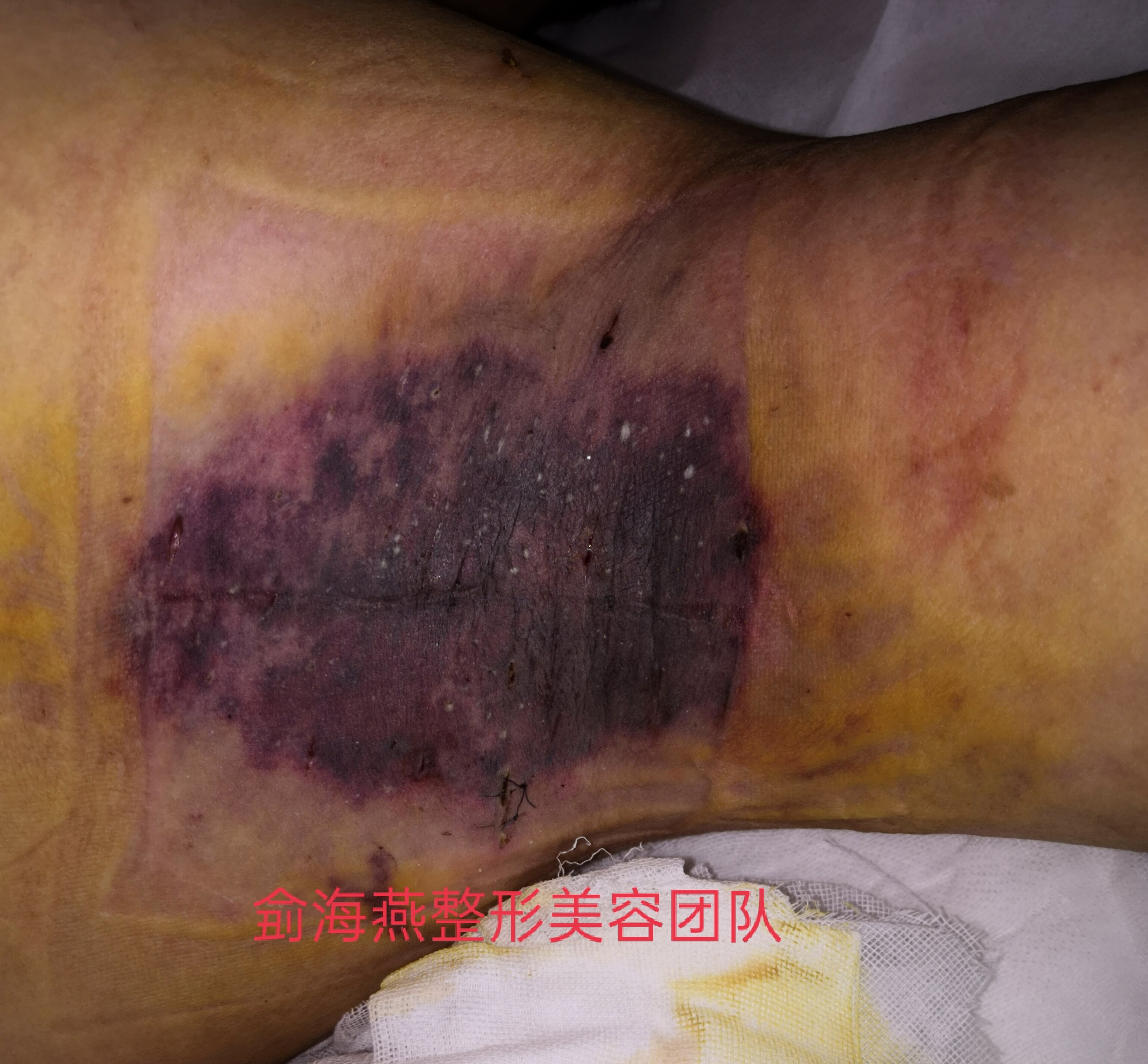 所谓的微创手术导致皮肤坏死的案例河南省人民医院整形外科侴海燕专家