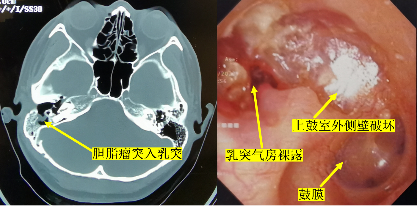 外耳道胆脂瘤的诊治