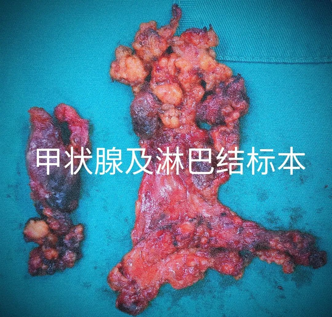 腔镜辅助侧颈淋巴结清扫手术患者顺利出院