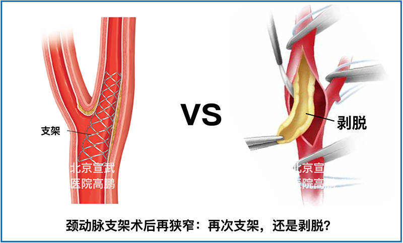 一个常见的话题颈动脉支架术后再狭窄该怎么办首选内膜剥脱来挽救