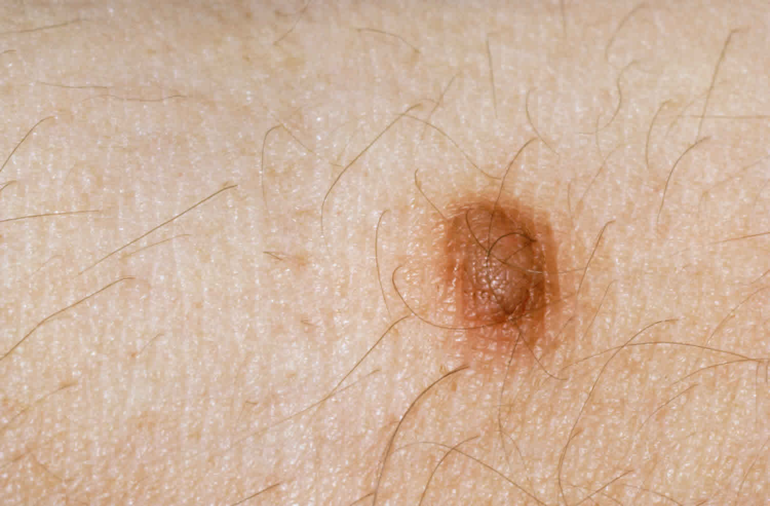 什么是皮肤纤维瘤?