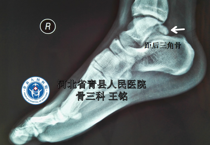 河北省青县人民医院骨三科后踝关节镜技术治疗距后三角骨损伤