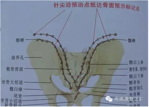 髂腰肌一一解剖针刀