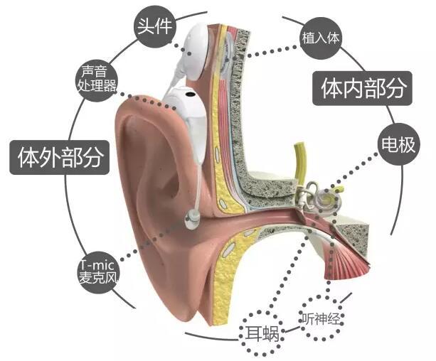 为电信号插入耳蜗内的电极释放电信号刺激神经(耳蜗轴上的螺旋神经节