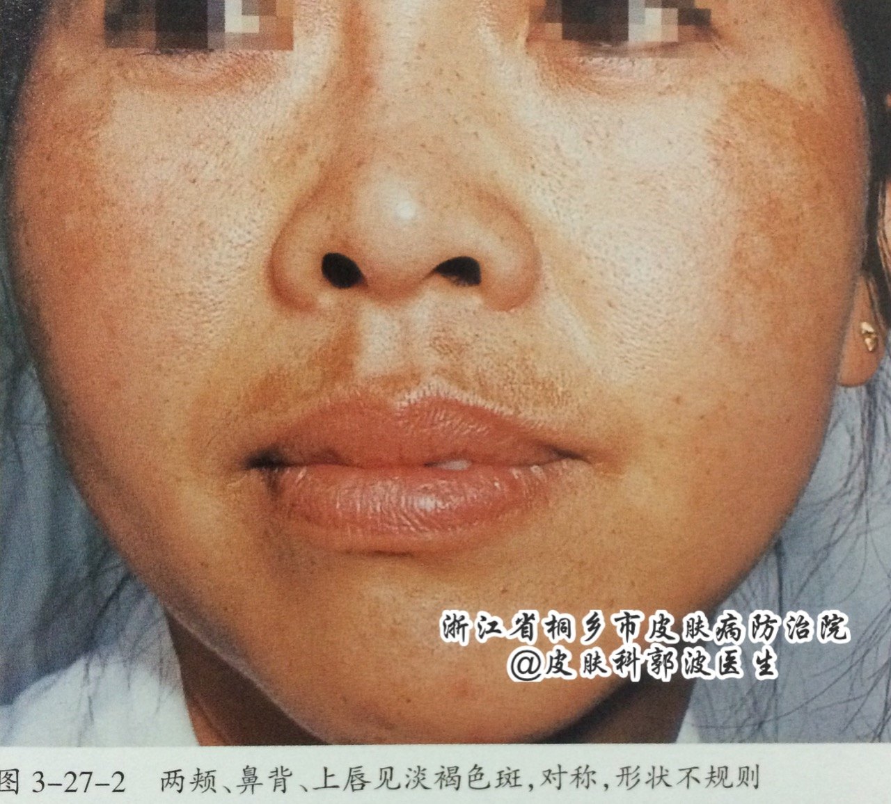 黄褐斑(melasma)是一种面部获得性色素增加性皮肤病,中医称为"黧黑斑"