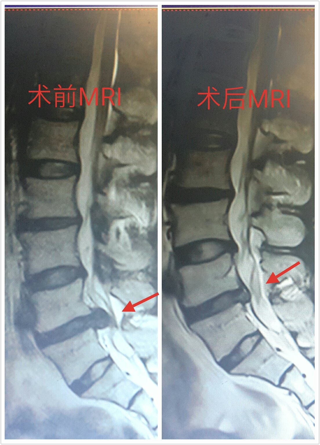 腰椎间盘突出症经脊柱内镜微创手术前后影像资料对比