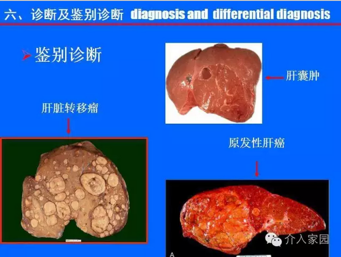 肝脏海绵状血管瘤-基础与介入