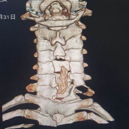 脊柱神经外科典型病例介绍之一(颈椎篇-范医生