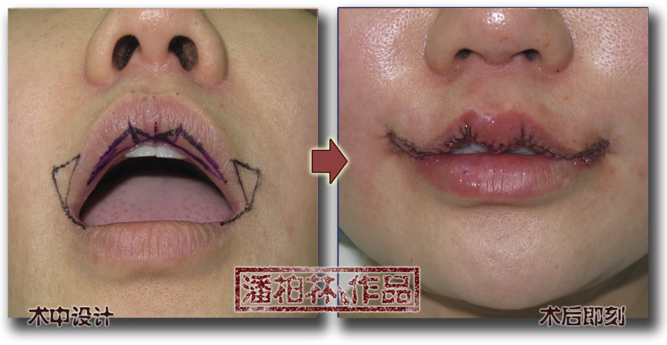 案例7:"微笑唇"套餐:女,33岁,上唇m唇 口角上提手术.术前与术后1月