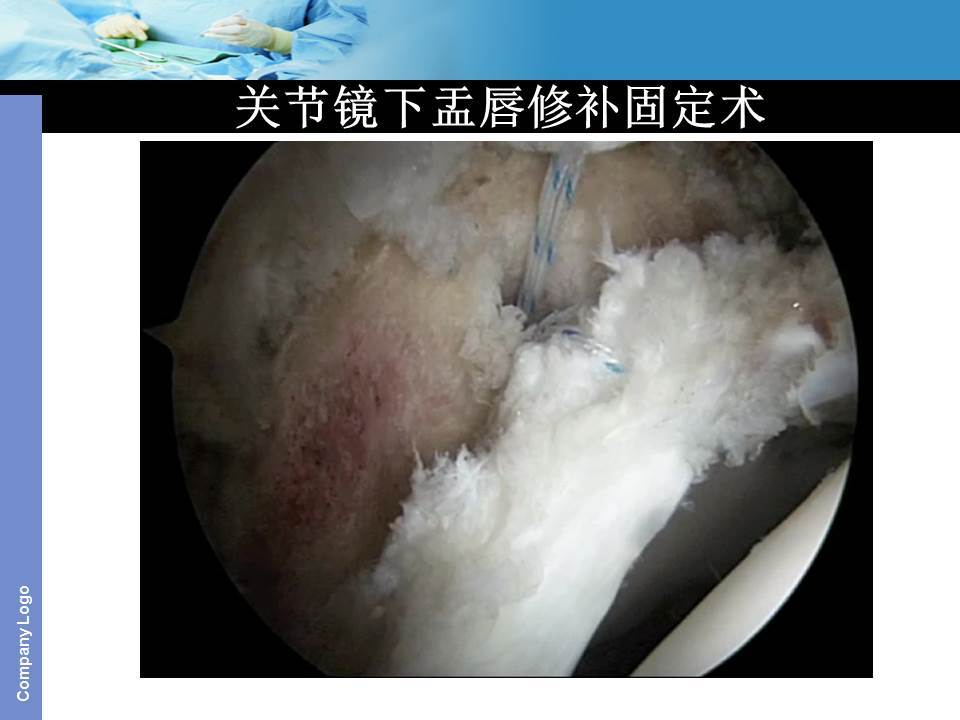 保髋手术基础入门篇