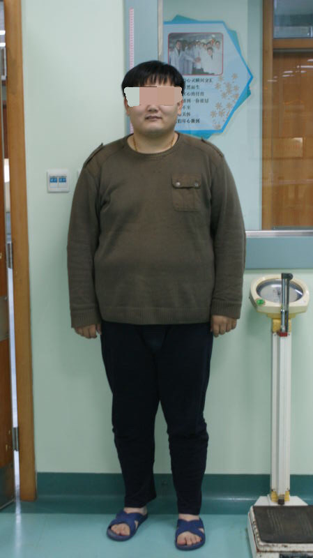 袖状胃切除术减肥手术介绍(之二)_肥胖症_疾病