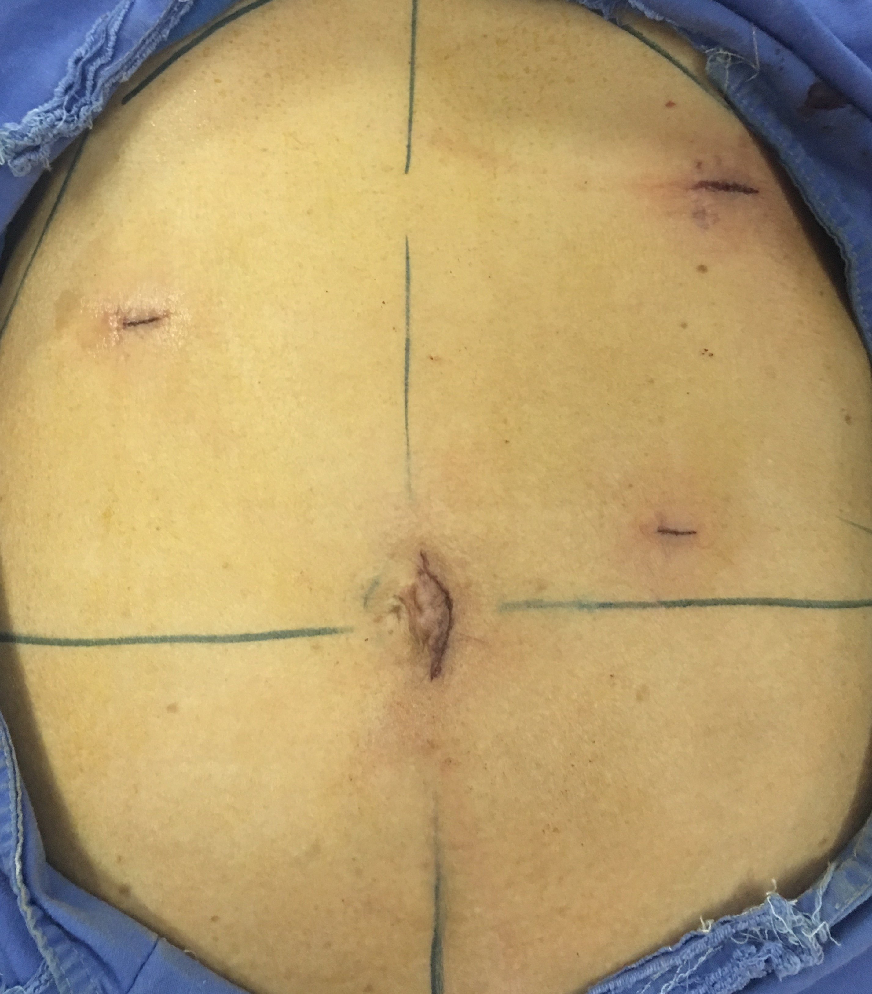 胃间质瘤患者腹腔镜微创手术后切口照片