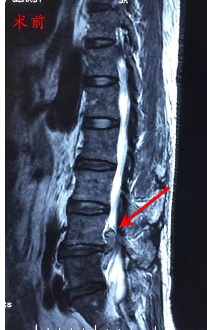 巨大型腰椎间盘突出症的微创手术治疗