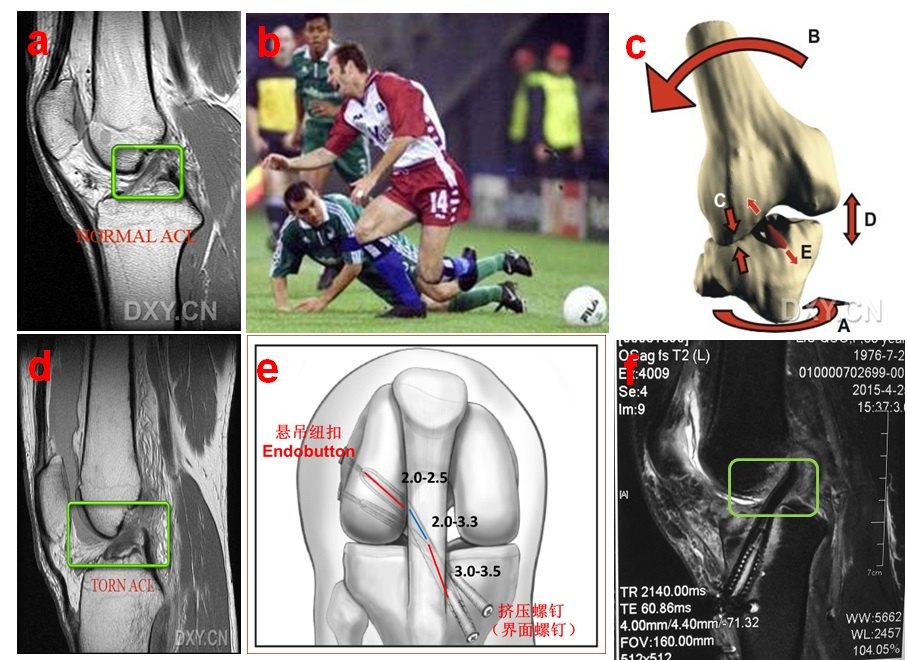 1483363613440587.jpg ACL重建-2.jpg