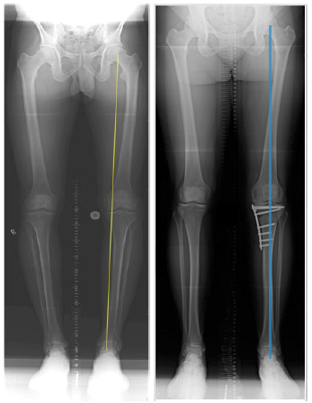 leg-xray-showing-high-tibial-osteotomy.png