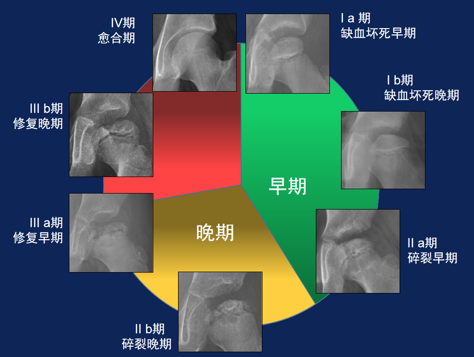 (perthes病) 儿童股骨头坏死 - - - 治与该怎么治的纠结