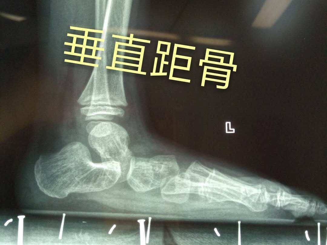 先天性垂直距骨是什么疾病治疗难度大吗