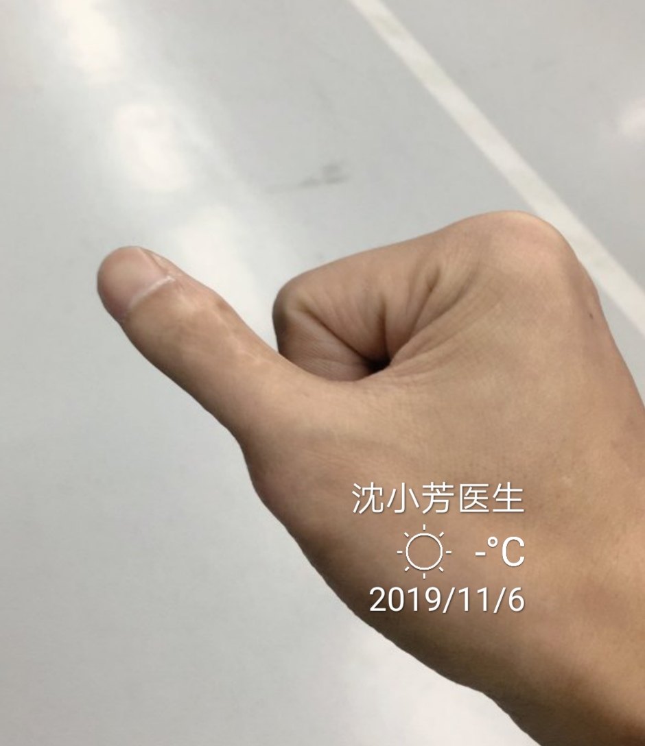 对于手指的外形及功能有需求进行再次矫正的都可以找我手术.