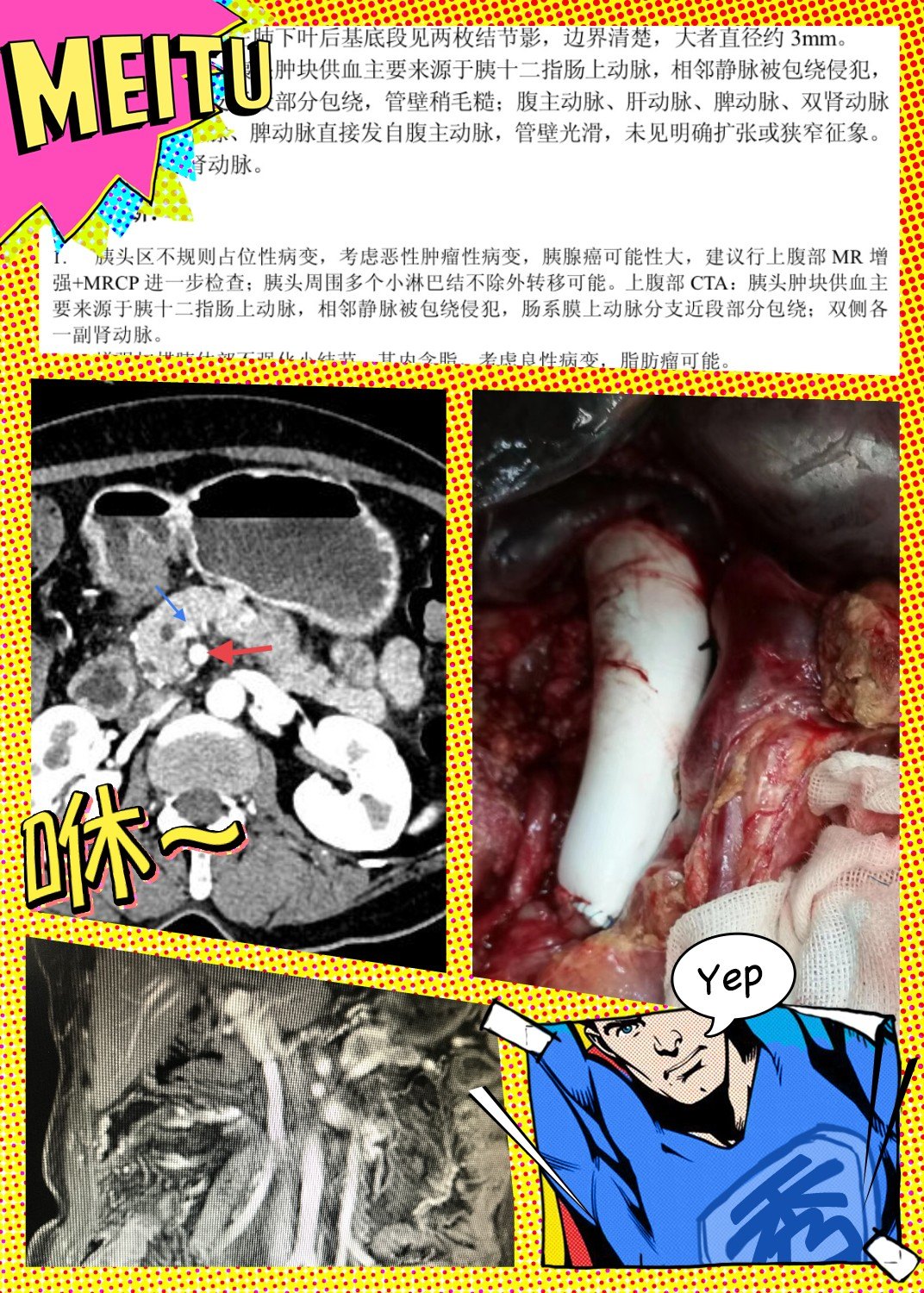 他4天内完成7台复杂胰腺大手术!