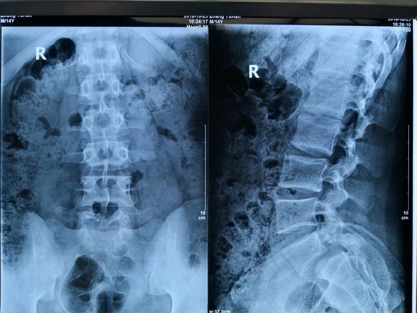 诊断:患者为腰椎滑脱症(腰5椎体双侧椎弓峡部裂 腰5椎体前滑脱ii度)