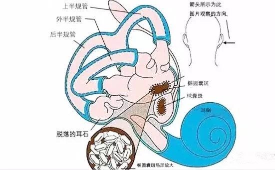 什么是耳石症?