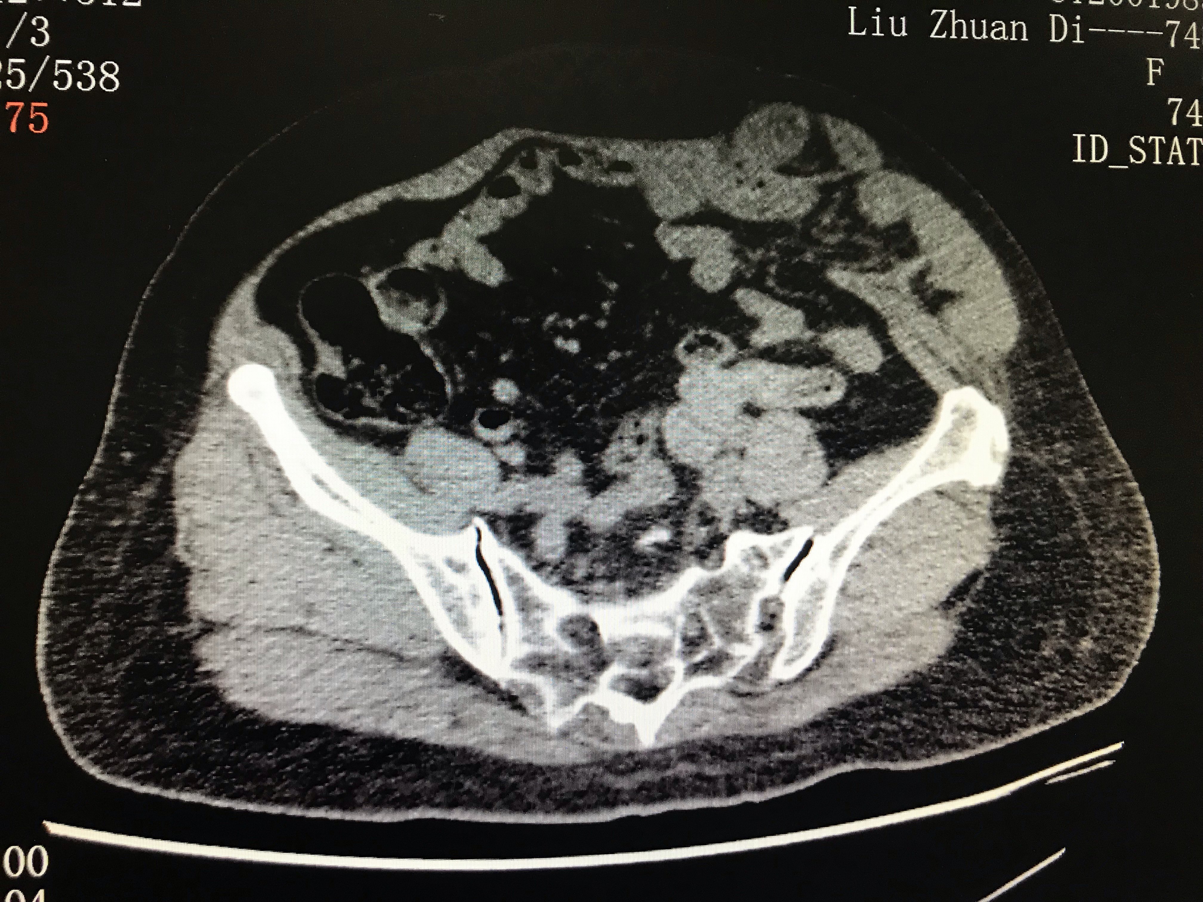 腹腔镜逆行扩大腹膜前腹壁切口疝无张力修补术