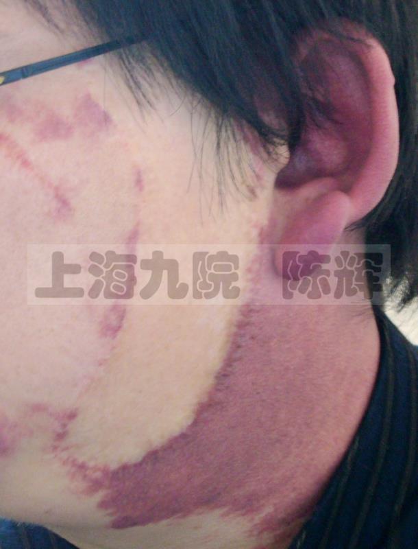 图19: 葡萄酒色斑的植皮修复,色差小(他院手术)
