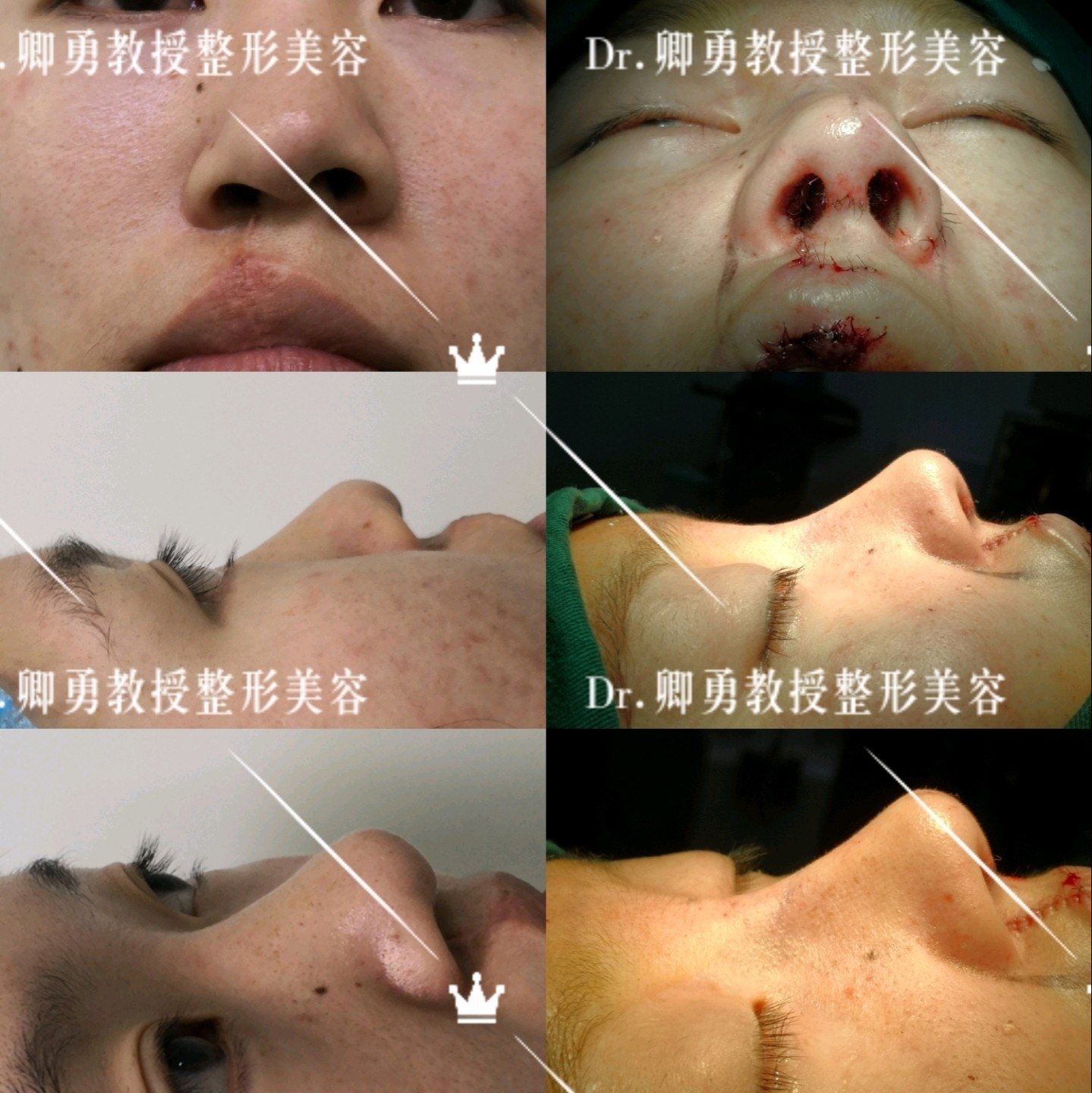 唇腭裂术后畸形往往需要肋软骨进行修复,基本达到正常鼻形态