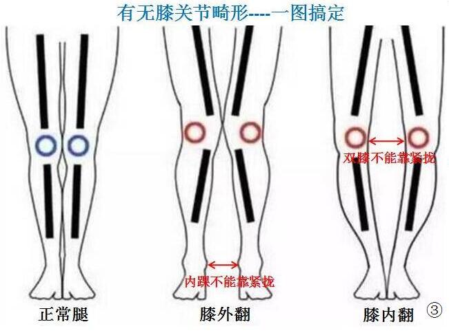 一图教你识别膝关节是内翻(o形腿)还是外翻(x形腿)