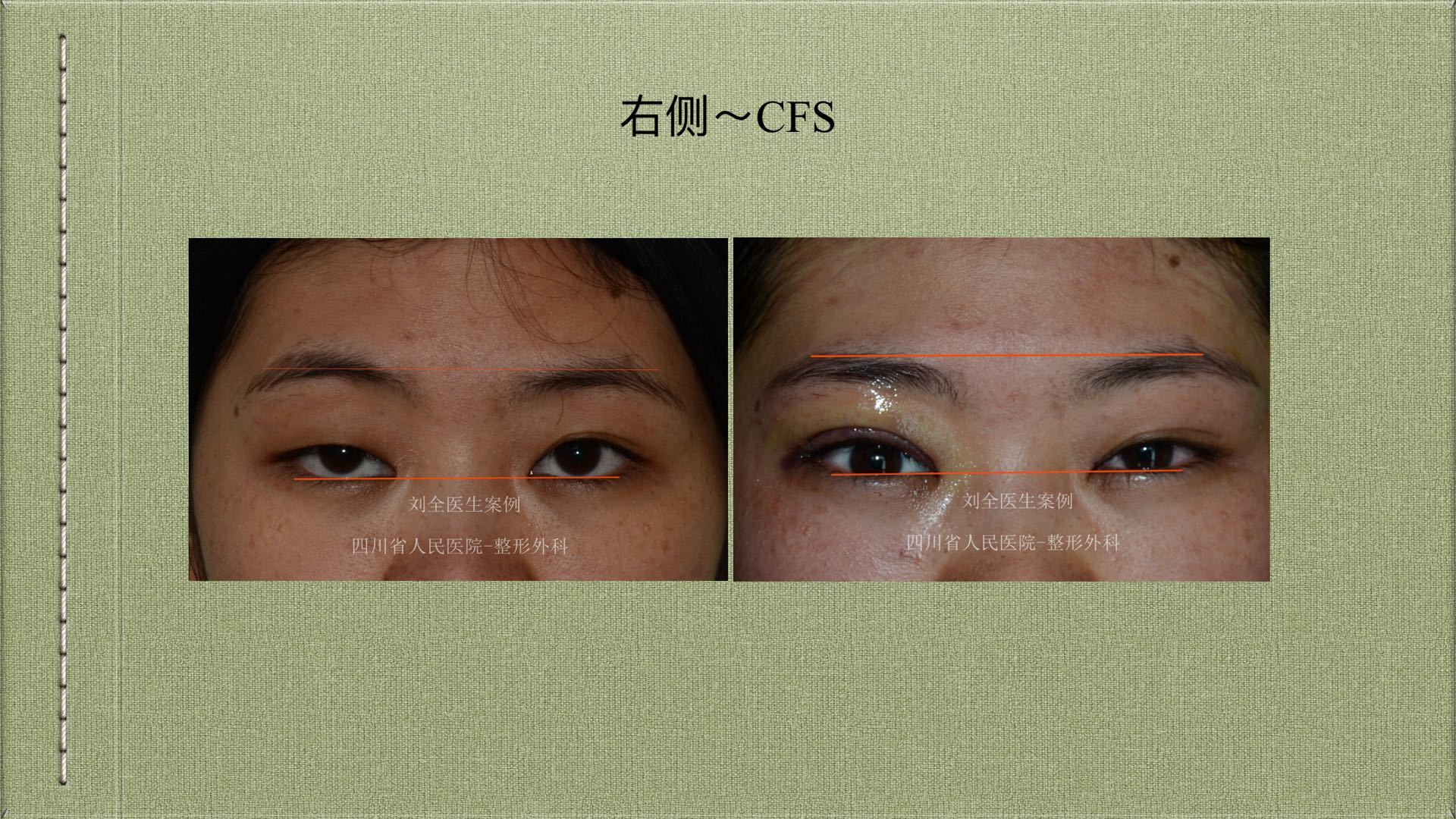 cfs～上睑下垂,用案例说话