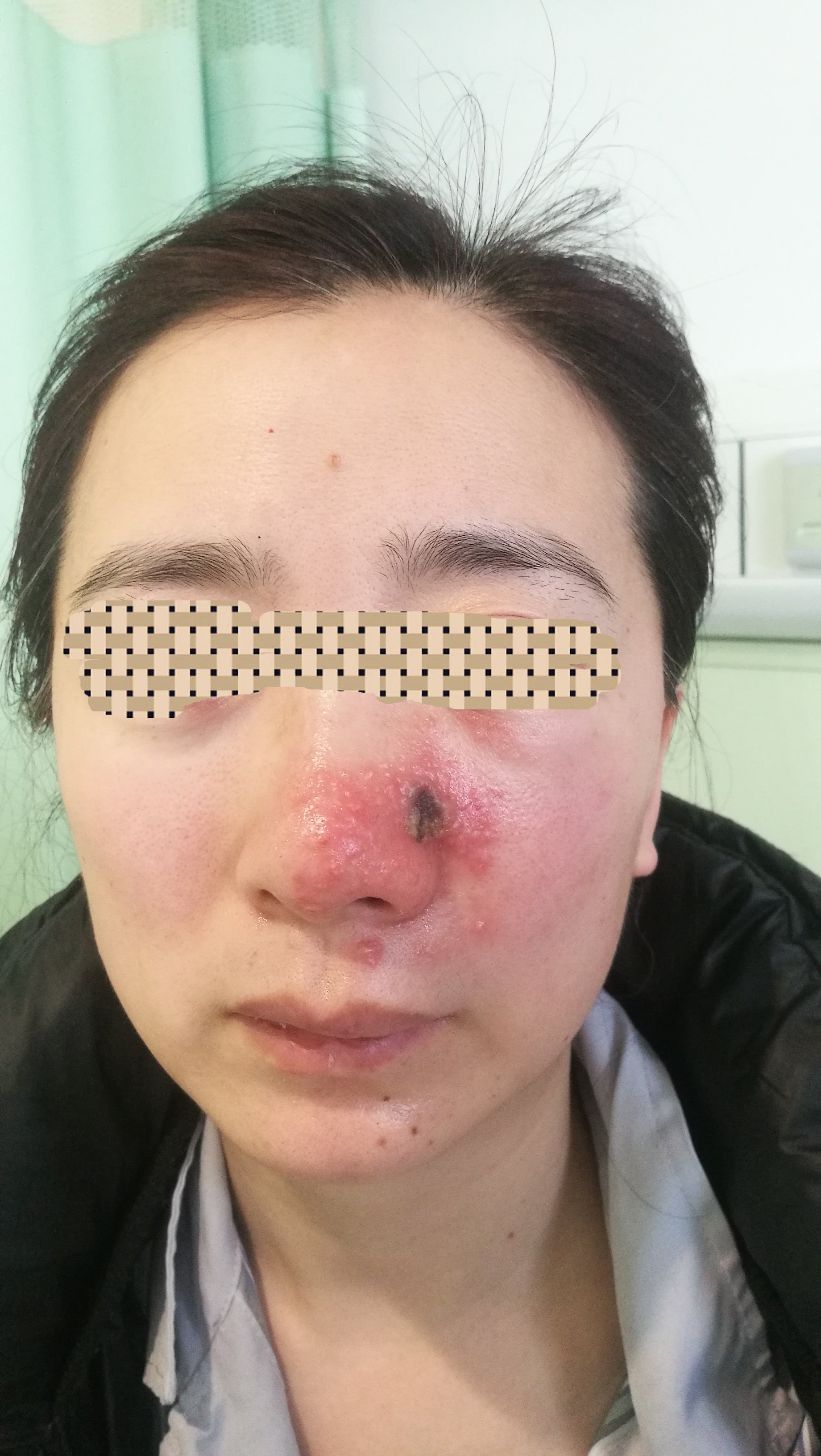 鼻面部危险三角区的感染值得重视(图)