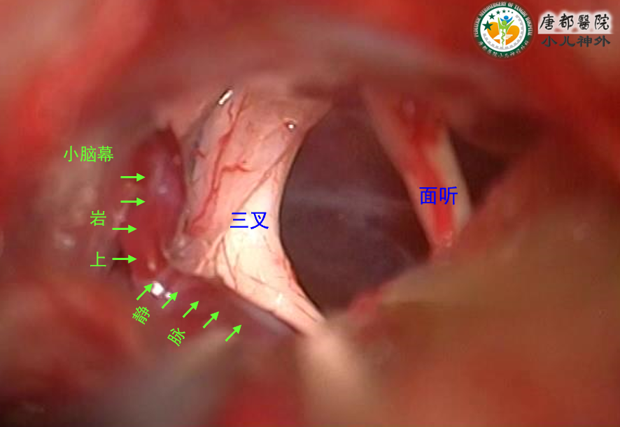 儿童后颅窝表皮样囊肿(胆脂瘤)病例分享