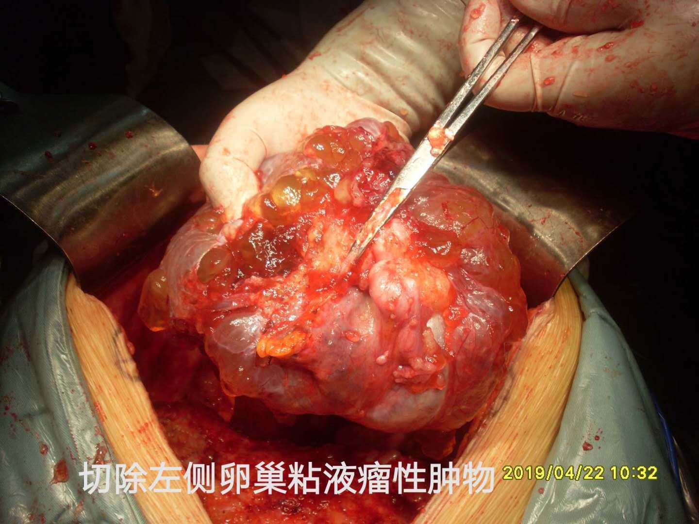 病例48--女性高腹压pmp导致呼吸困难