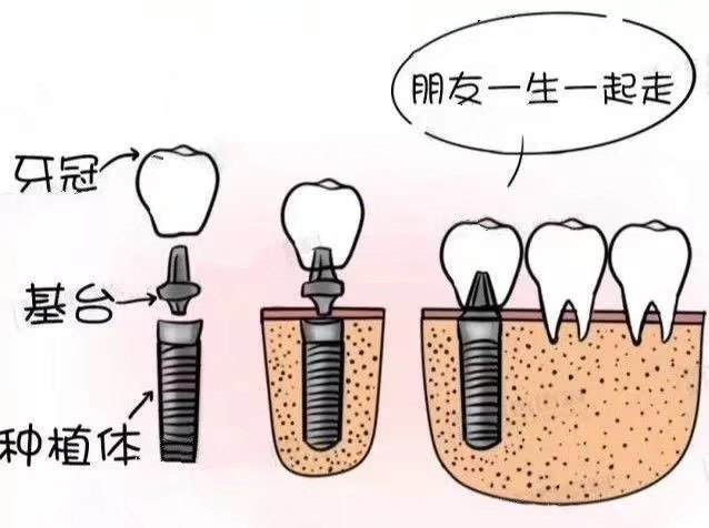 一图看懂种植牙  种植牙——你人生的第三副牙[机智]